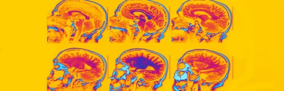 Brain scans put more extreme ADHD in focus